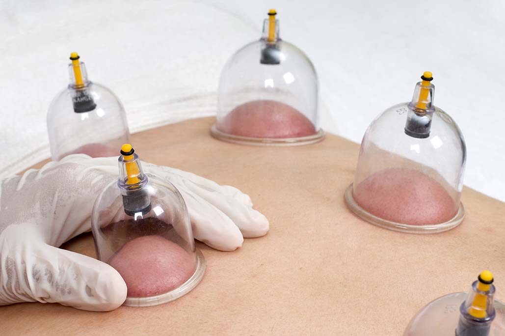 Dry Cupping Therapy 